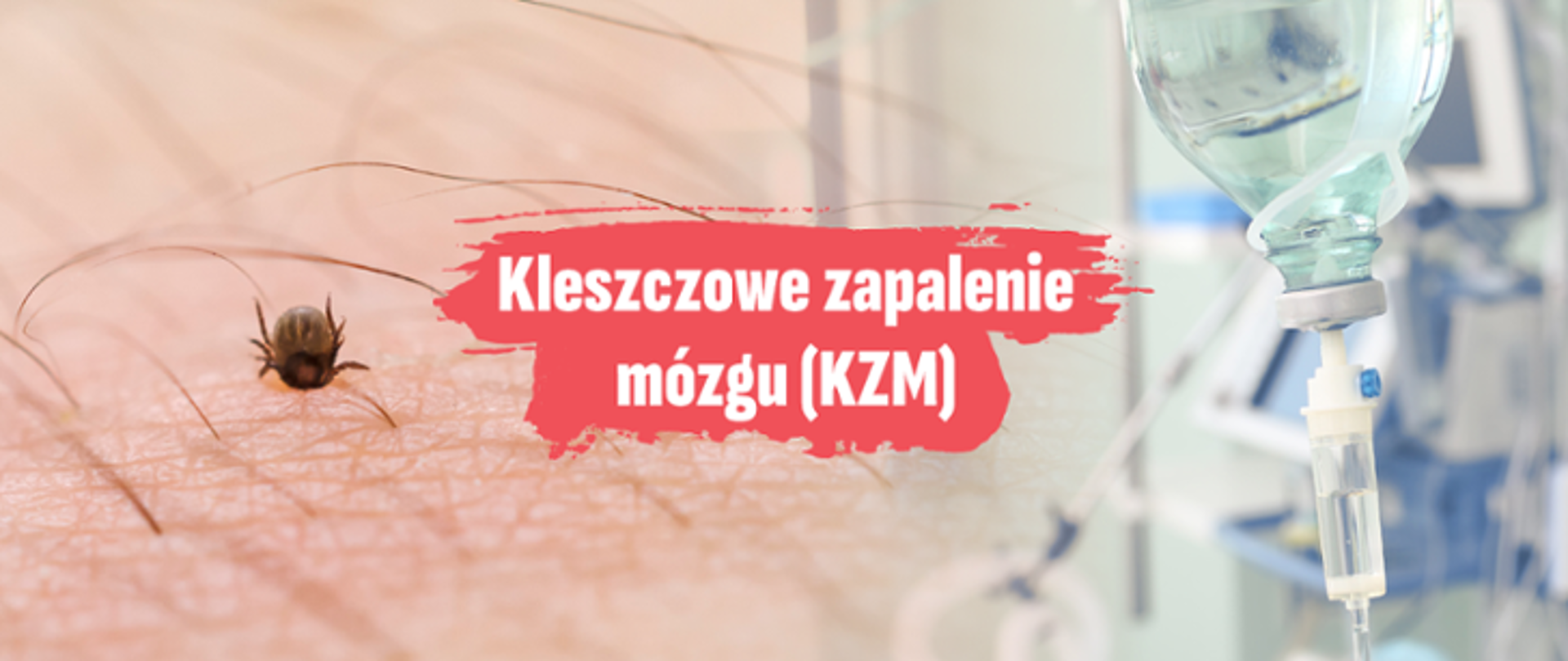 Grafika przedstawia kleszcza na ludzkiej skórze po lewej stronie oraz kroplówkę medyczną po prawej. Na środku znajduje się napis: „Kleszczowe zapalenie mózgu (KZM)” na czerwonym tle.