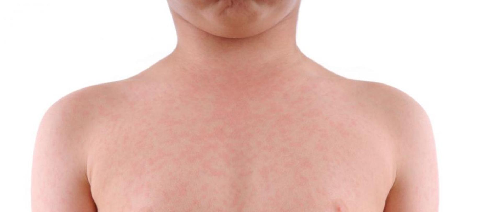 ODRA - wygląd wysypki na skórze