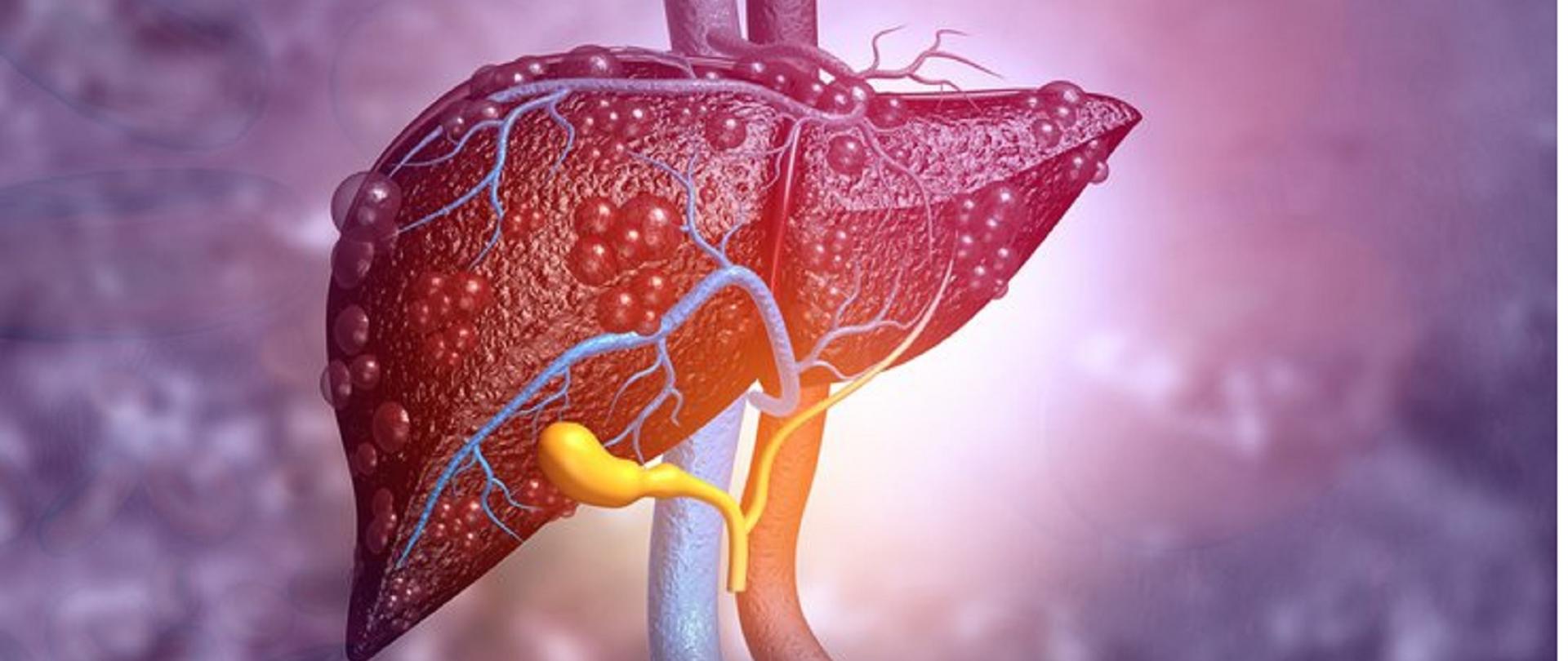 Ludzka wątroba zaatakowana przez WZW typu A