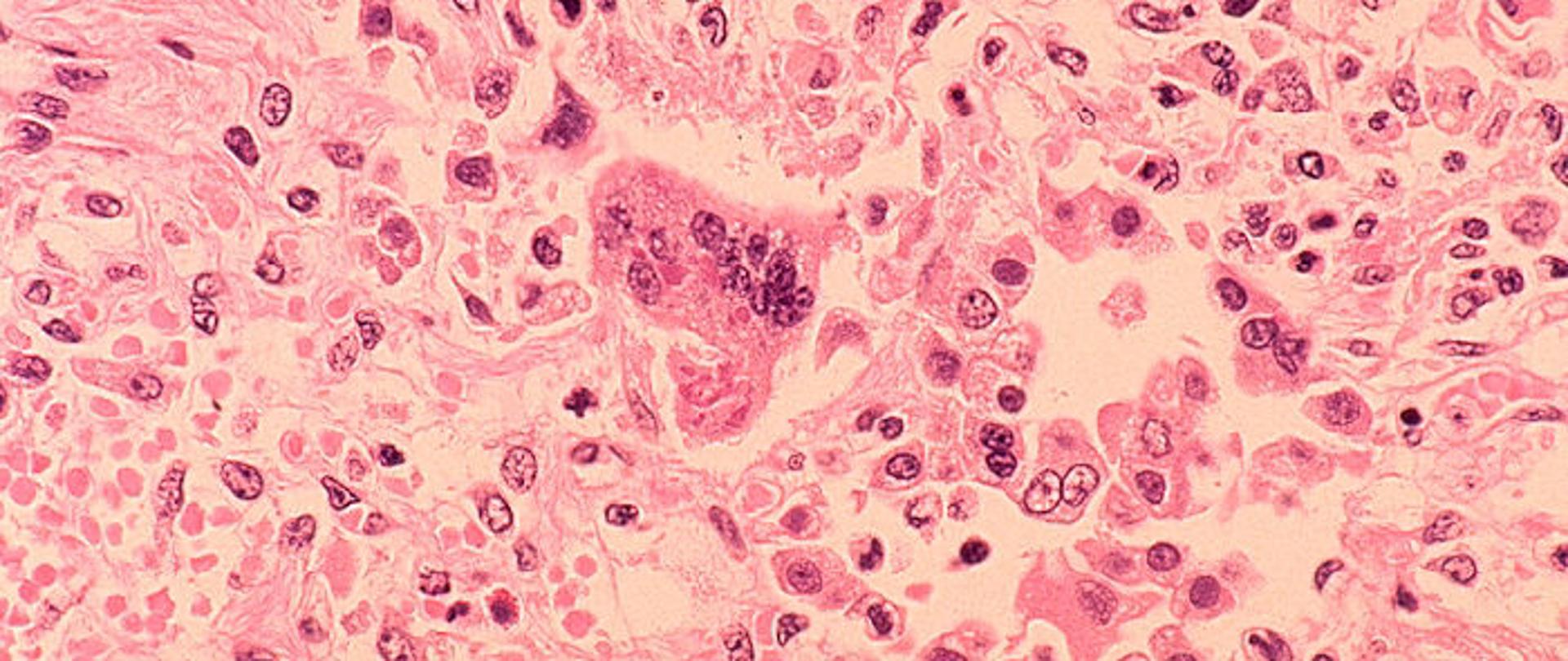 mikroskopowe zdjęcie drobnoustrojów wywołujących odrę