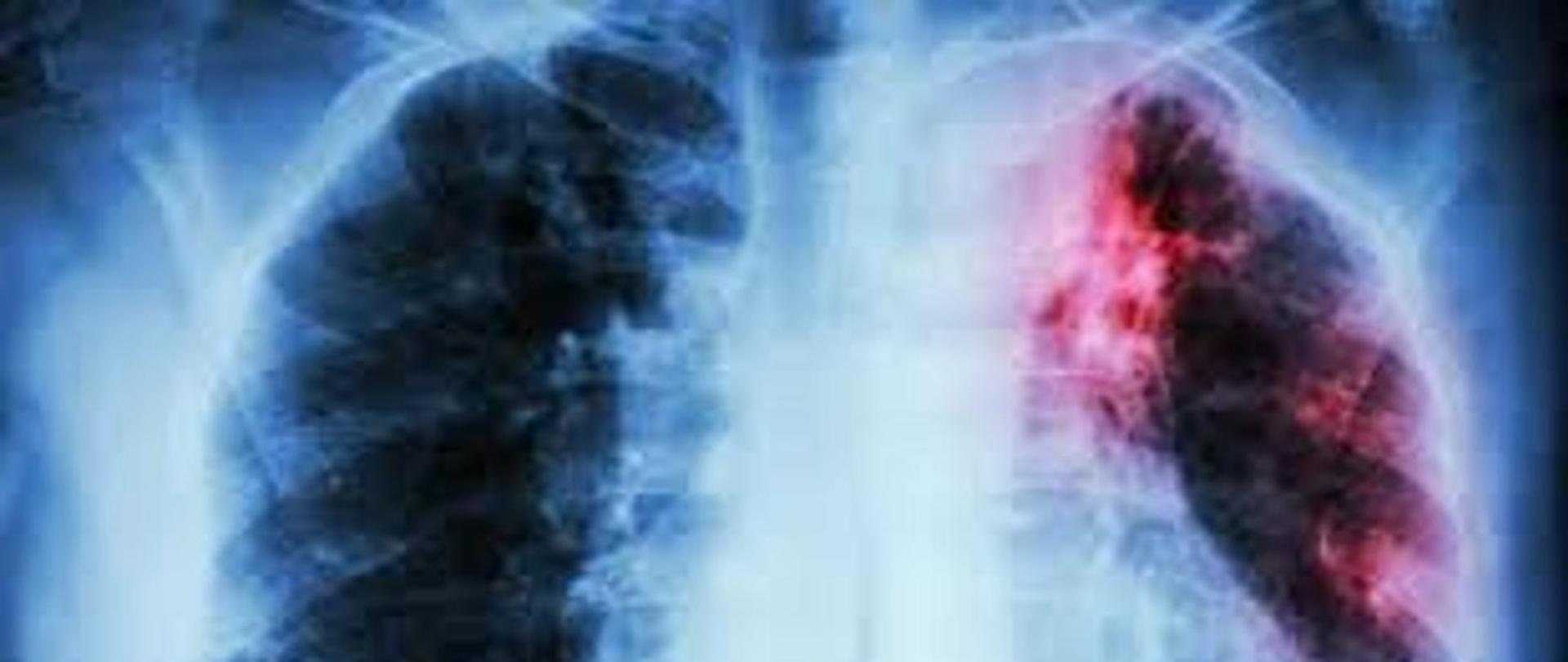 Gruźlica – nadal groźna choroba zakaźna