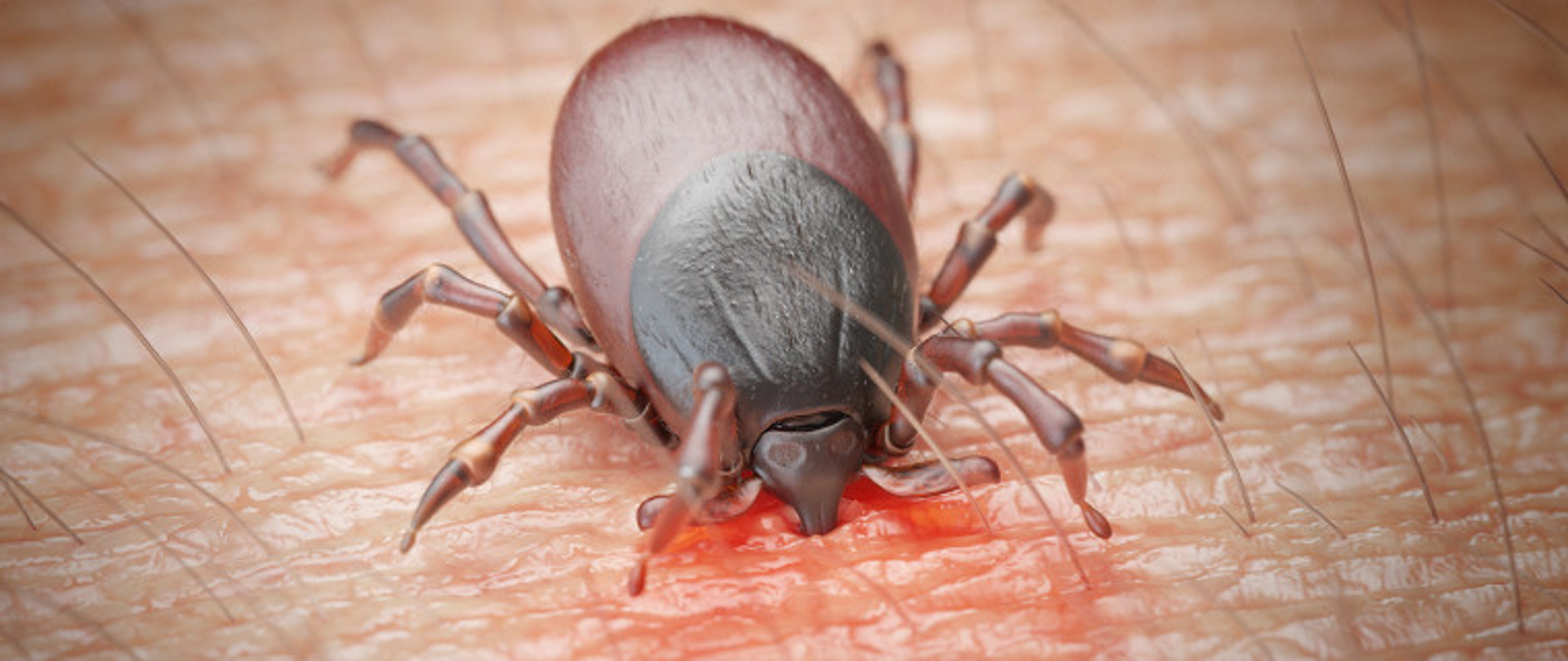 Kleszcz na skórze człowieka wysysający krew 