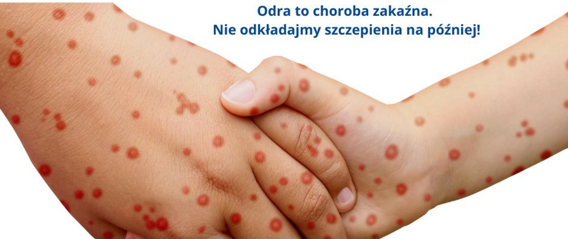 Zbliżenie na na ręce z objawami odry i hasło "odra to choroba zakaźna nie odkładajmy szczepienia na później!"
