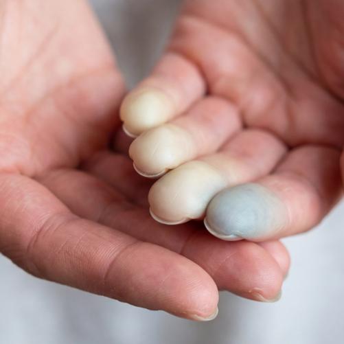 Na zdjęciu widać dwie dłonie, trzy palce jednej z nich są do połowy długości białe, a jeden biało-siny.