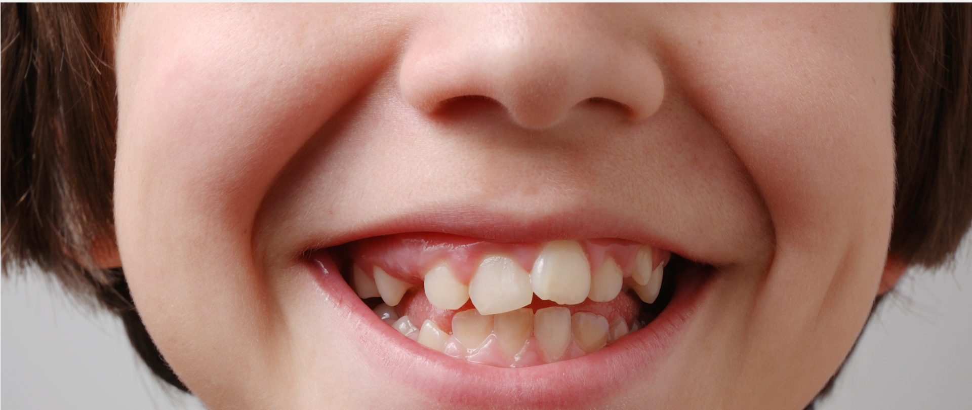 Młody chłopiec z krzywymi zębami uśmiecha się przed założeniem aparatu ortodontycznego.