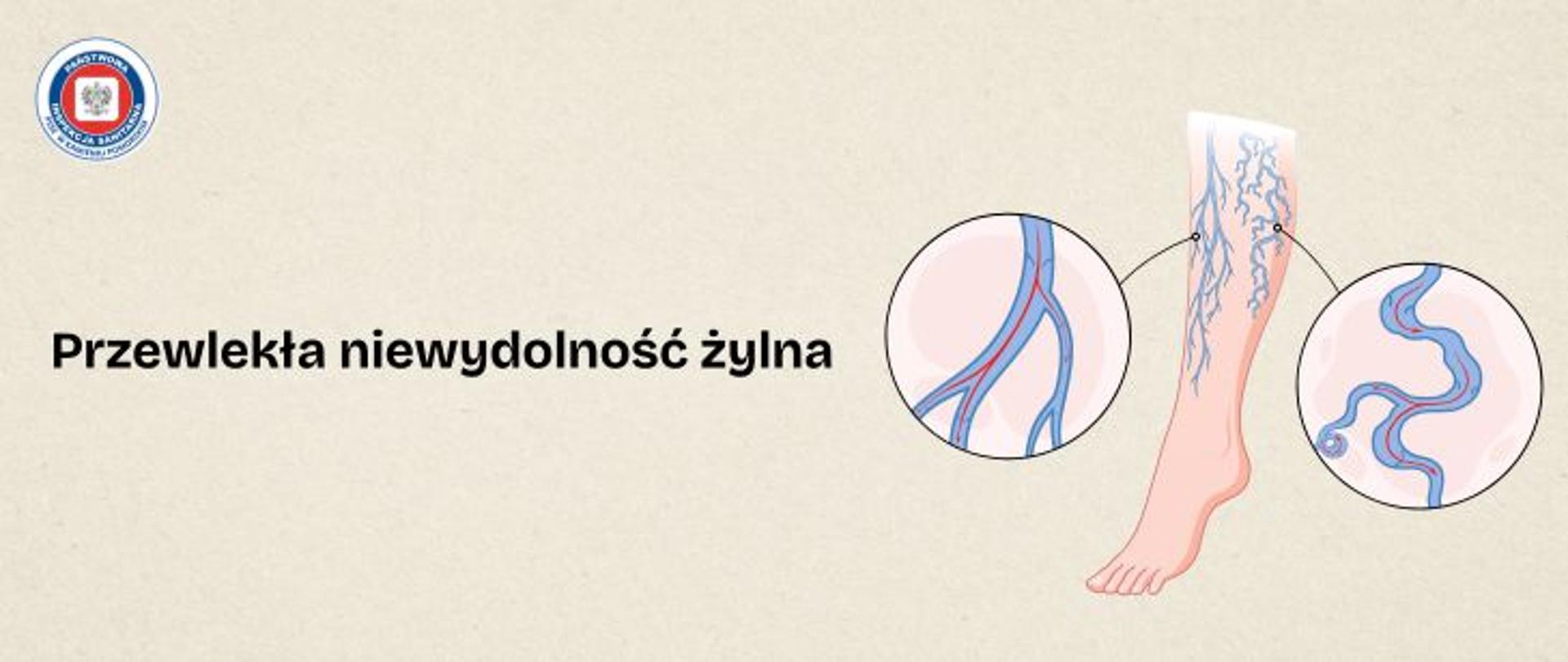 Grafika przedstawia nogę - łydkę i stopę oraz układ żył. Dodatkowo po prawej i lewej stronie od łydki znajdują się zbliżenia na układ żylny. Po lewej stronie znajduje się czarny napis Przewlekła niewydolność żylna. W lewym górnym rogu znajduje się logo Państwowej Inspekcji Sanitarnej. 
